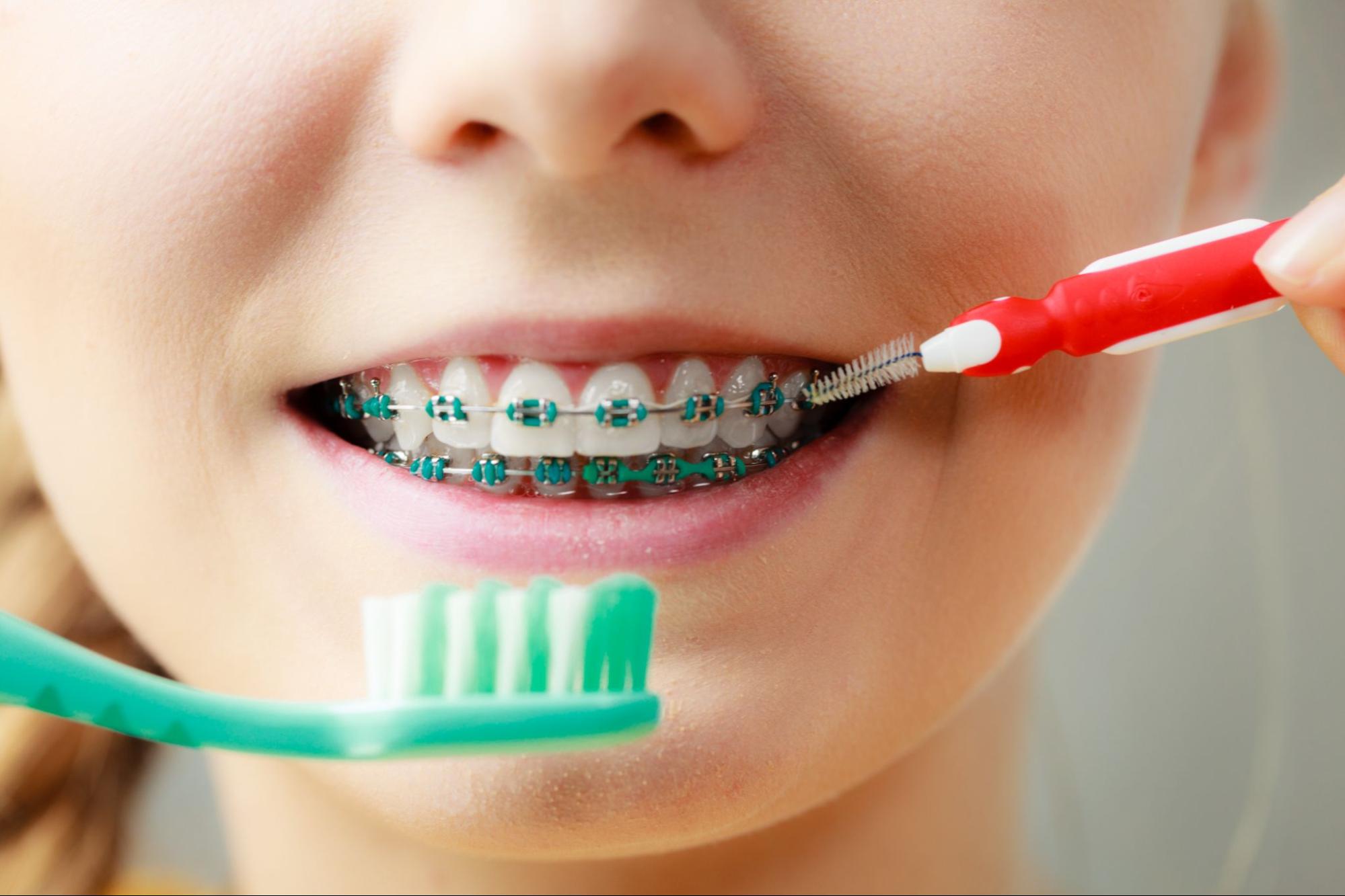 Tips for Keeping Your Braces Clean
